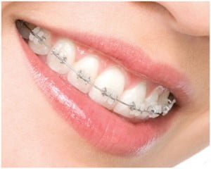 aparat dentar metalic